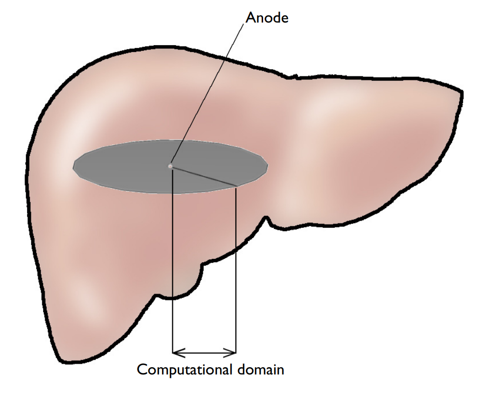EChT模型的肝脏，肿瘤和阳极示意图。
